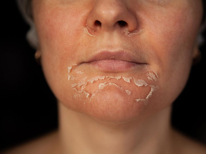 Woman with a chemical peel on her face.
